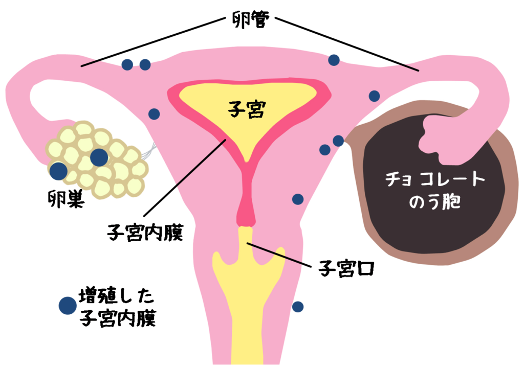 子宮内膜症の根本原因は内分泌かく乱物質と炎症とエストロゲン