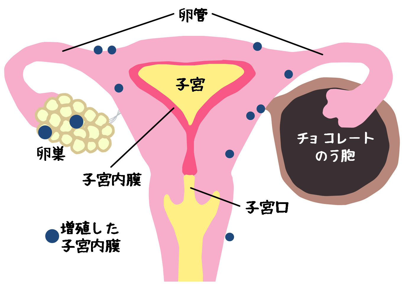 子宮内膜症の根本原因は内分泌かく乱物質と炎症とエストロゲン