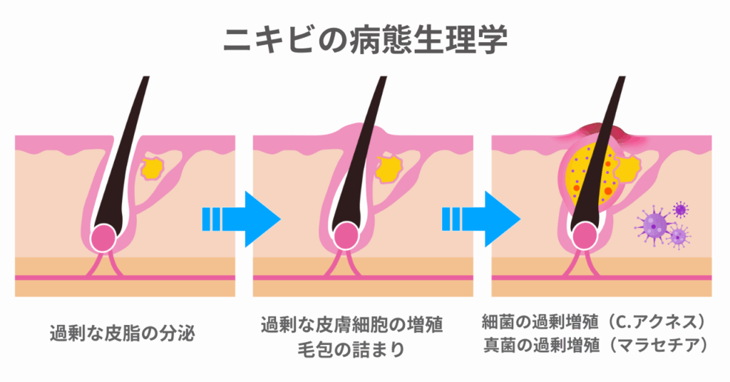大人ニキビの病態生理（皮脂増加・角質肥厚・毛穴の閉塞・炎症）

